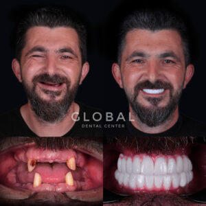 all-on-six-implants-turkey-img-4