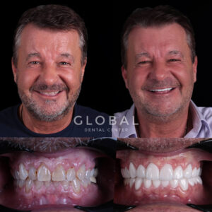 dental-crowns-turkey-img-1