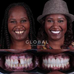 dental-crowns-turkey-img-2