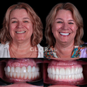 dental-implants-turkey-img-1