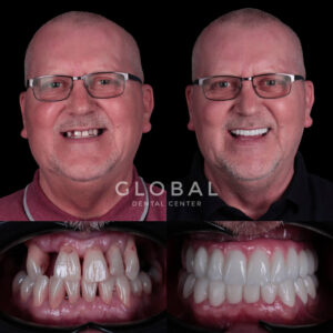 dental-implants-turkey-img-2