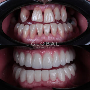 dental-implants-turkey-img-8