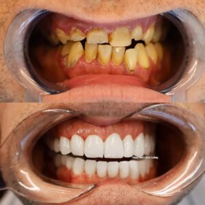 westdent-before-after-25