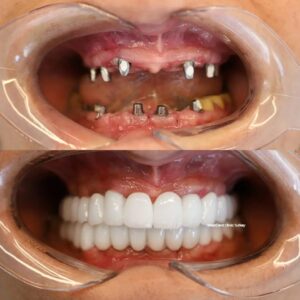 westdent-before-after-26